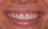 Crown Lengthening After